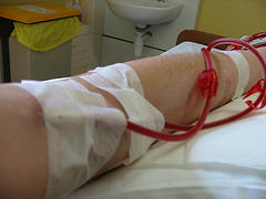Why Does US Have Worst Fatality Rate From Kidney Dialysis?