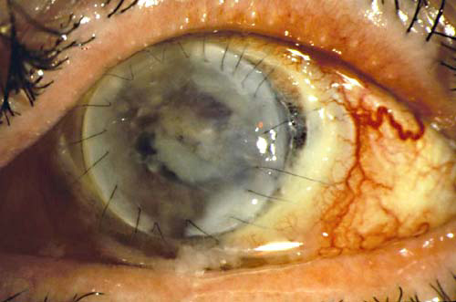 Pictures of Eyeball Fungus