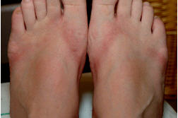 1 Year Later: Feet Scarred From "Chemical Flip Flops," Walmart Still Not Talking