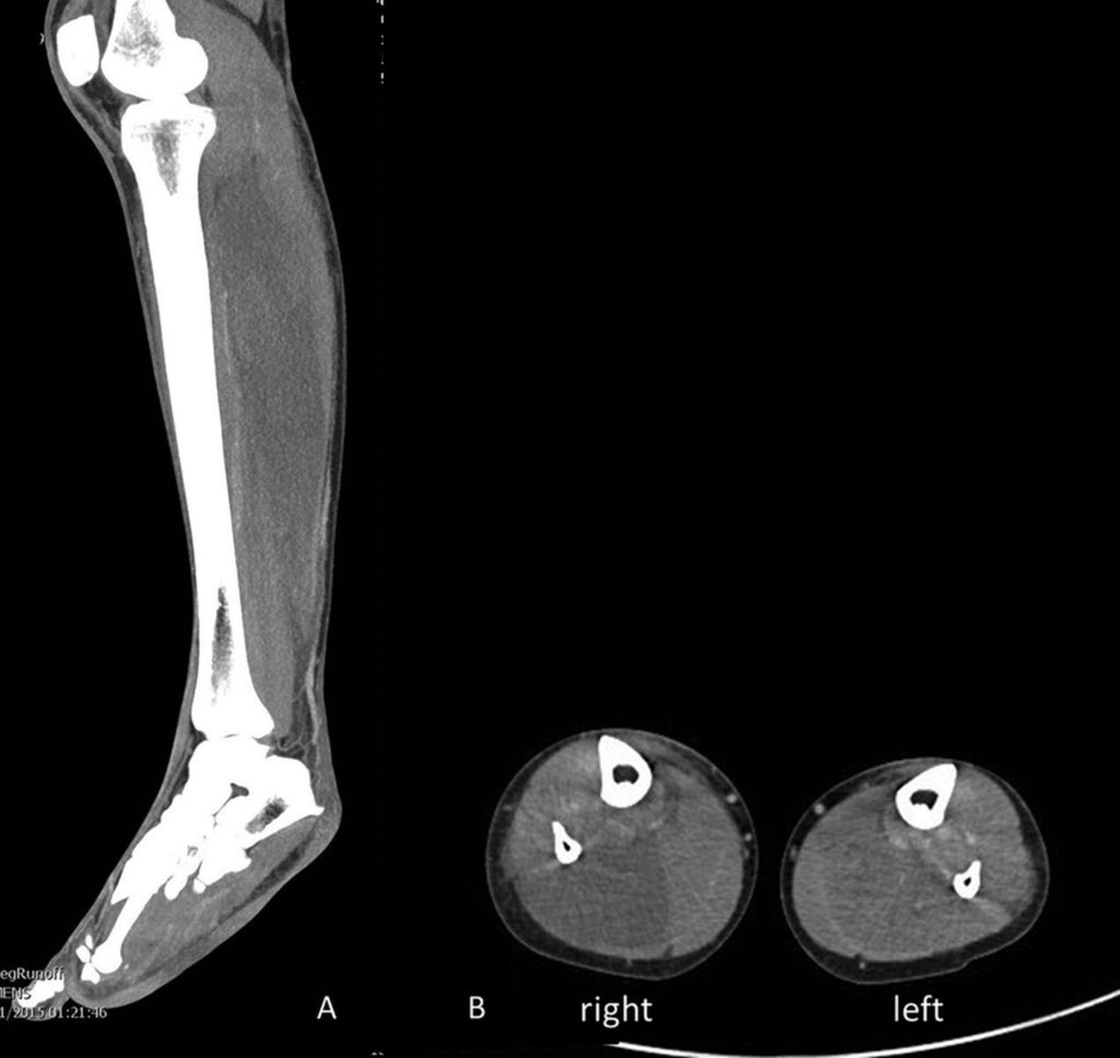 A CT scan of the right leg and scans of both lower legs showing "hypoattenuation and oedema of muscles of the posterior compartment of the calves, consistent with myonecrosis."