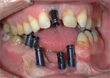 Some Outsourced Dental Implants Test Positive For Lead