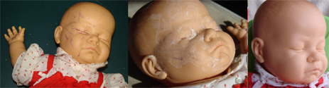 Remove Pen Marks From Dolls With Acne Medications