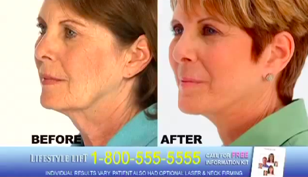 Here a Lifestyle Lift commercial claims to provide facelifts in just an hour. 
