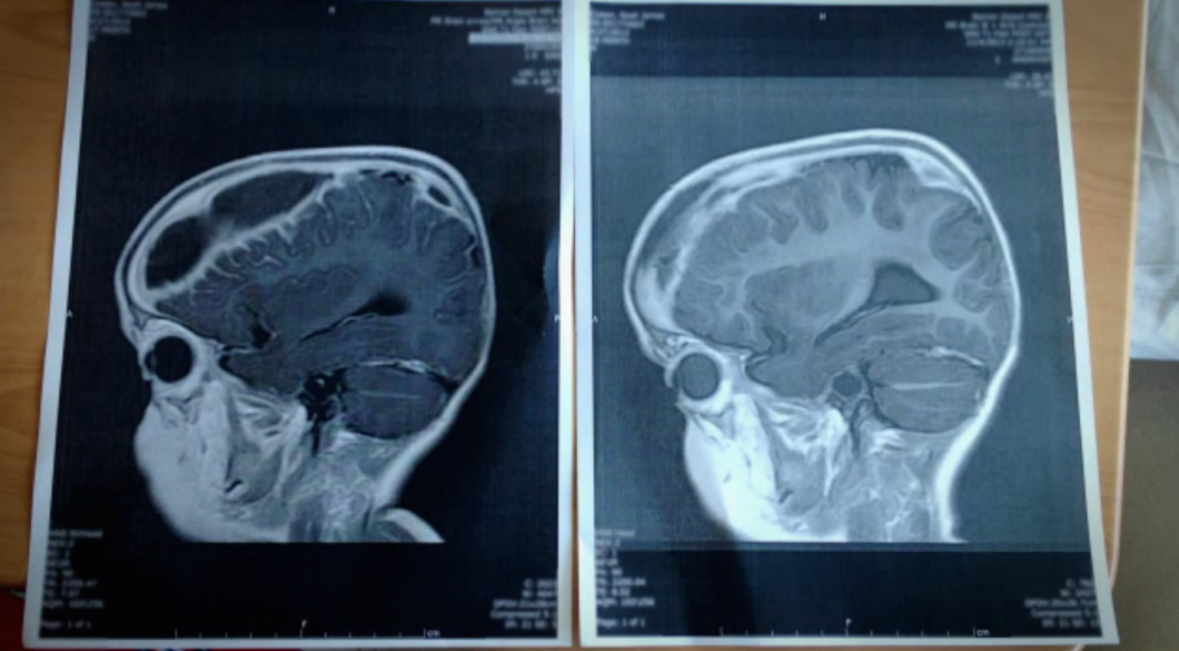 The MRI scan on the left shows the brain abscess  that developed in an 18-month-old Arizona boy within weeks of eating salmonella-tainted poultry. [Image via Frontline]