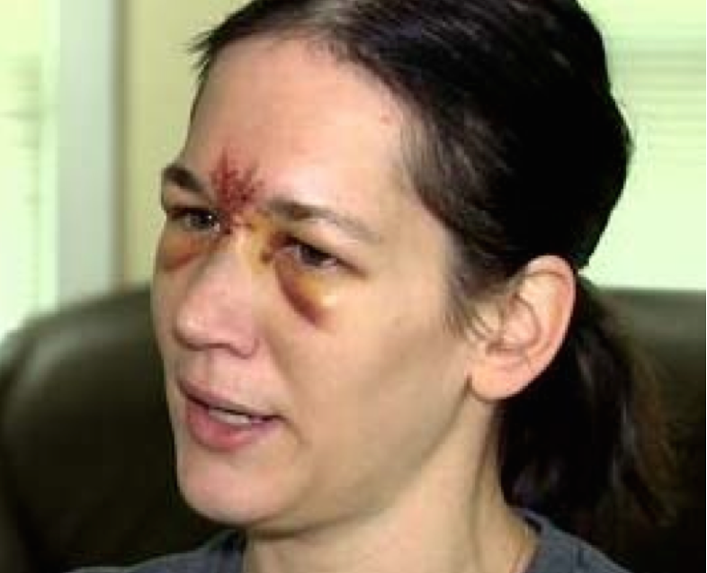 In July, this Connecticut woman was hospitalized and received 30 stitches after being hit in the forehead by a foul ball at Boston's Fenway Park.